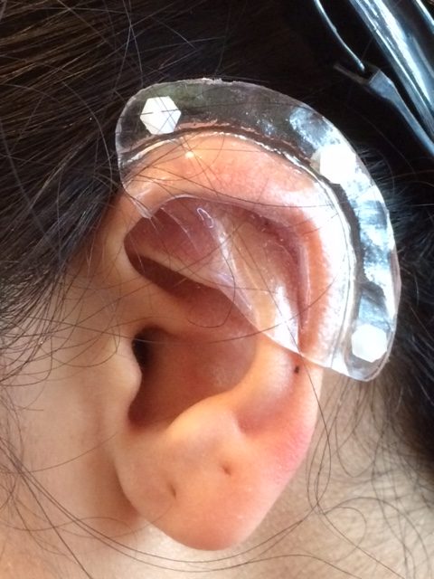 Ear Keloid Compression Plastic Discs Plastic Disc Earring for Post-op Keloid  Pressure'smiley' Shape 
