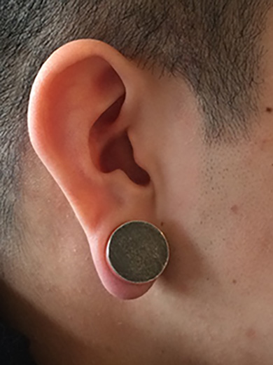 Ear Keloid Compression Earring  Certified Hand Therapist in